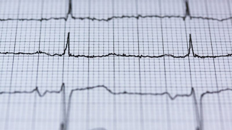 La montre connectée peut-elle remplacer l’appareil à ECG ?