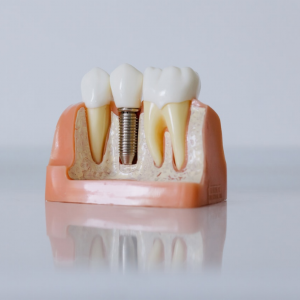 L’implant dentaire : tout ce qu’il y a a savoir