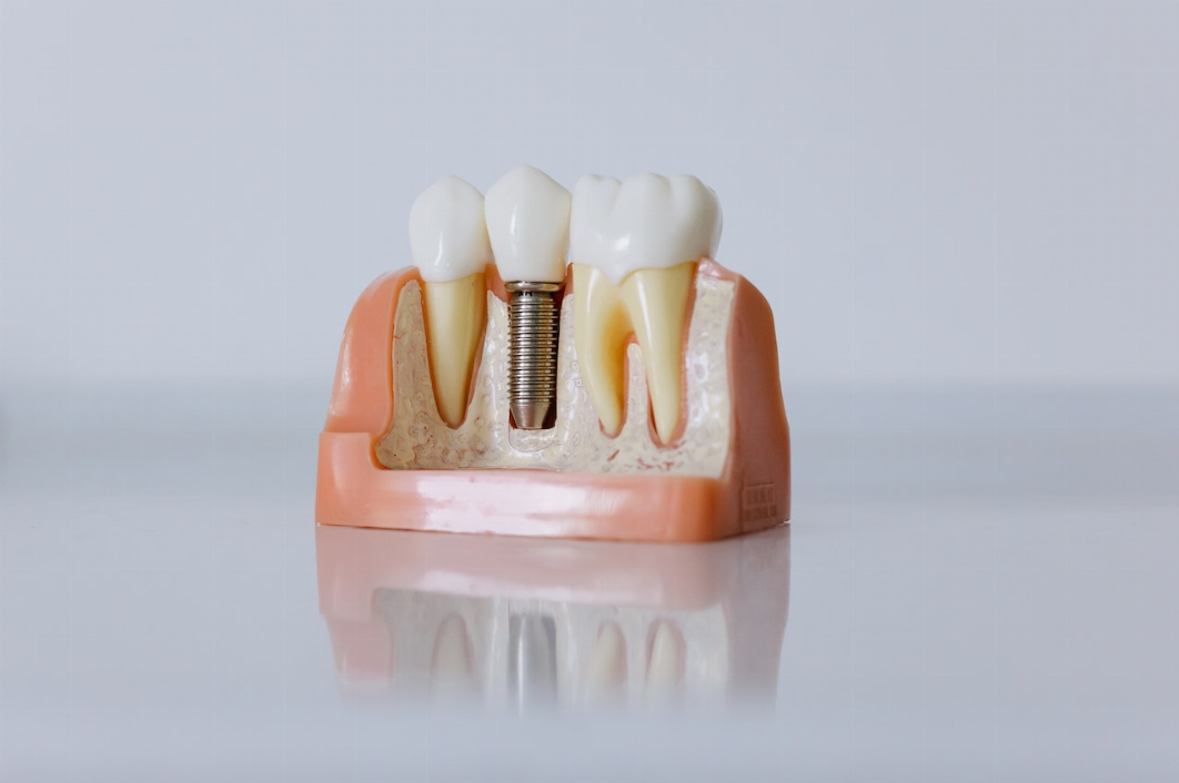 L’implant dentaire : tout ce qu’il y a a savoir